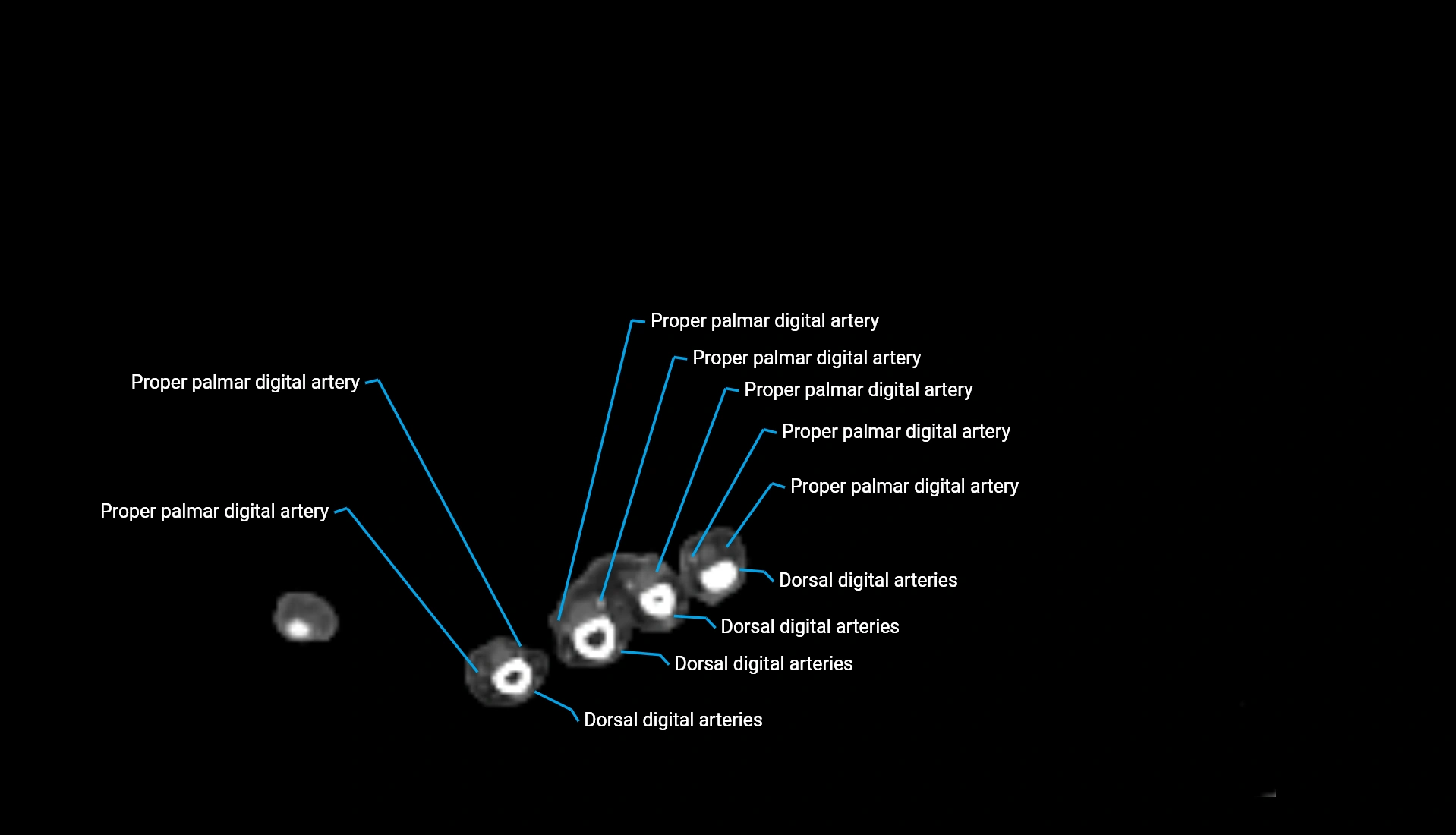 CTA upper limb axial cross sectional anatomy labelled image 37 (2).webp